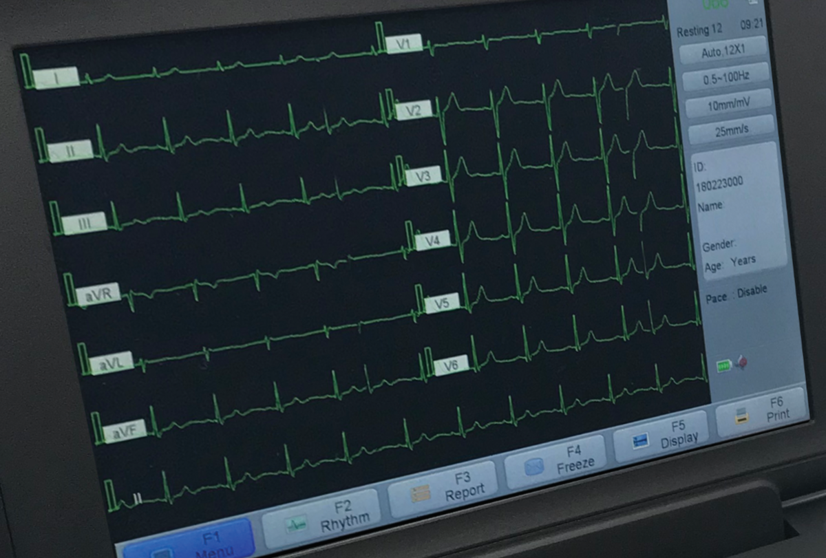 ekg-machines-how-do-they-work-infinium-medical