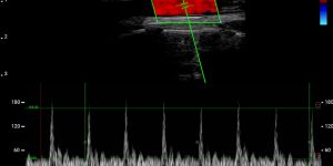 Carotid - Pulse Wave