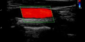 Carotid - Color Doppler
