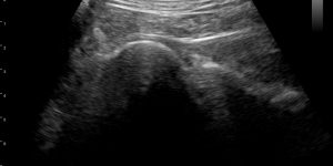 Humeral Cartilage