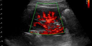 Kidney - Power Doppler
