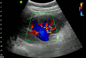 Kidney - Color Doppler