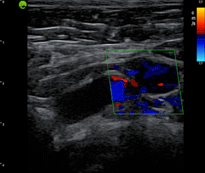 Post Vaccination Axillary Lymph Node Hyperplasia - Color Doppler